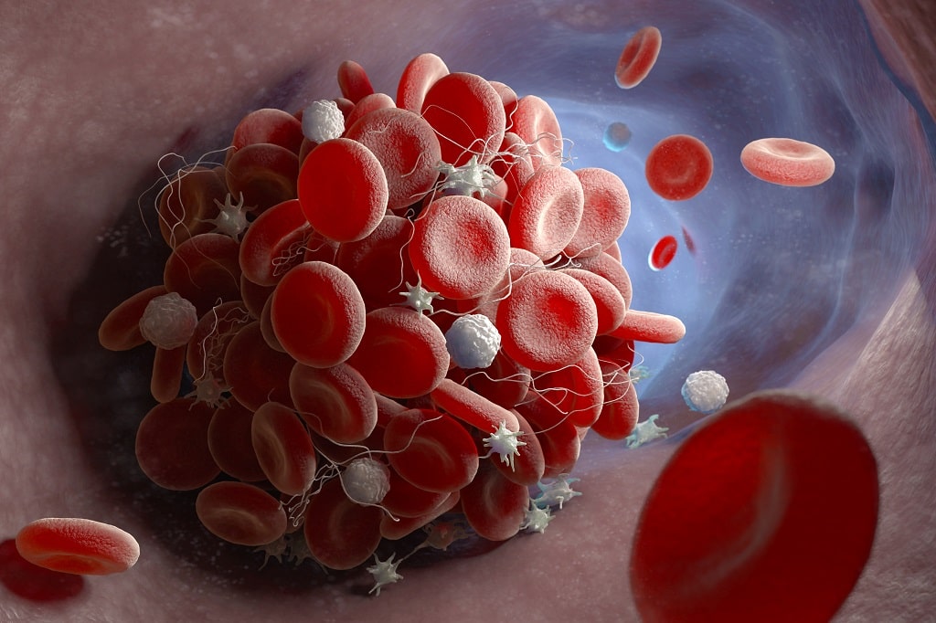 Can varicose veins cause blood clots