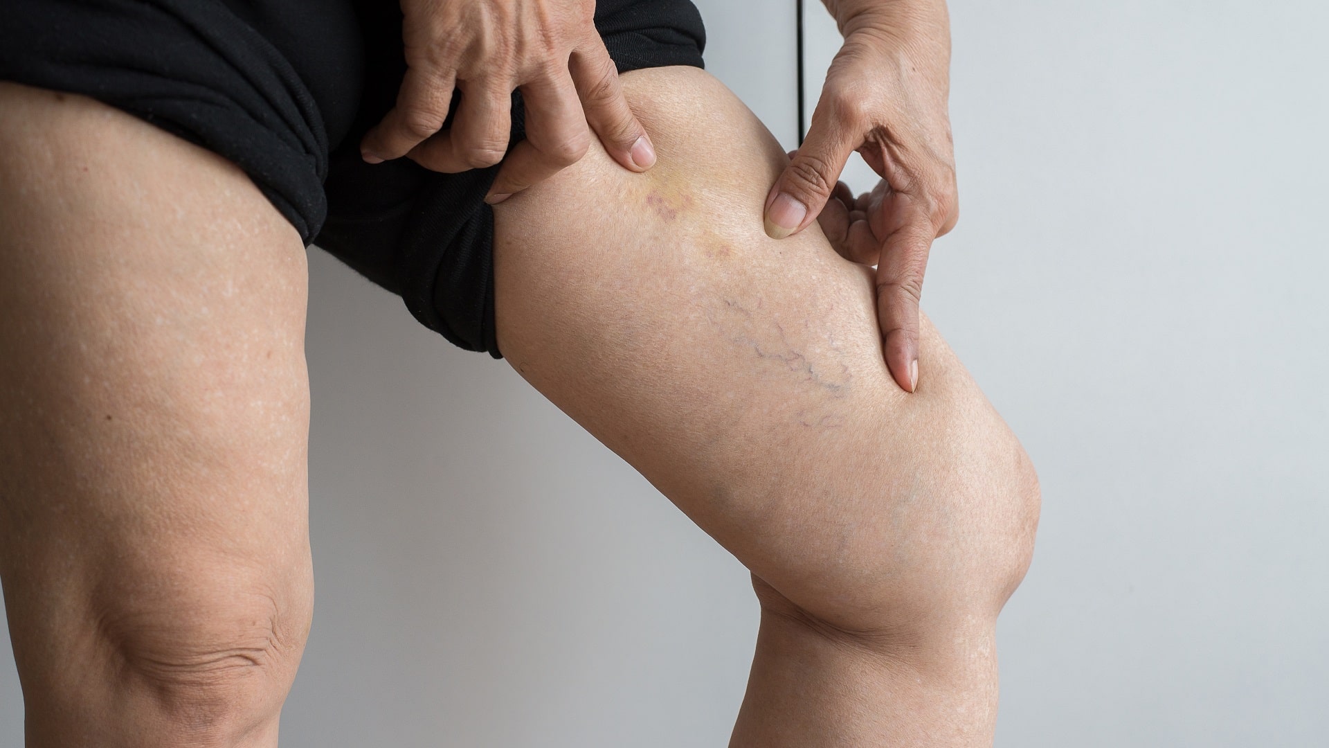How to get rid of spider veins