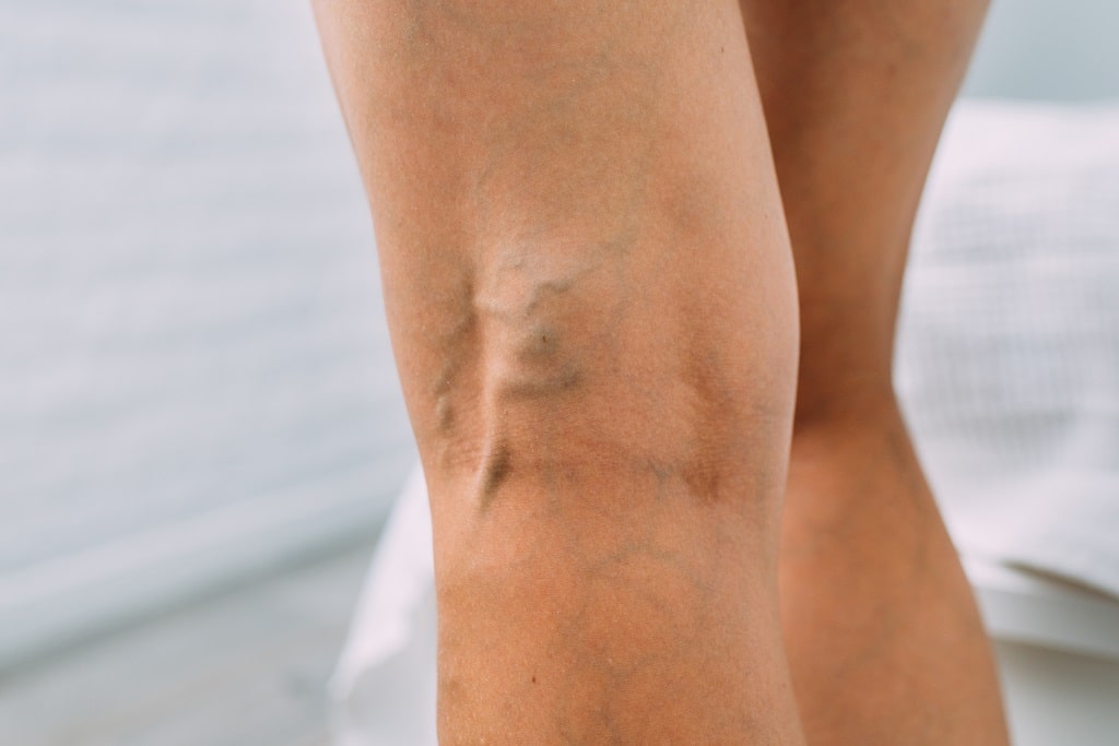 What are the stages of chronic venous insufficiency