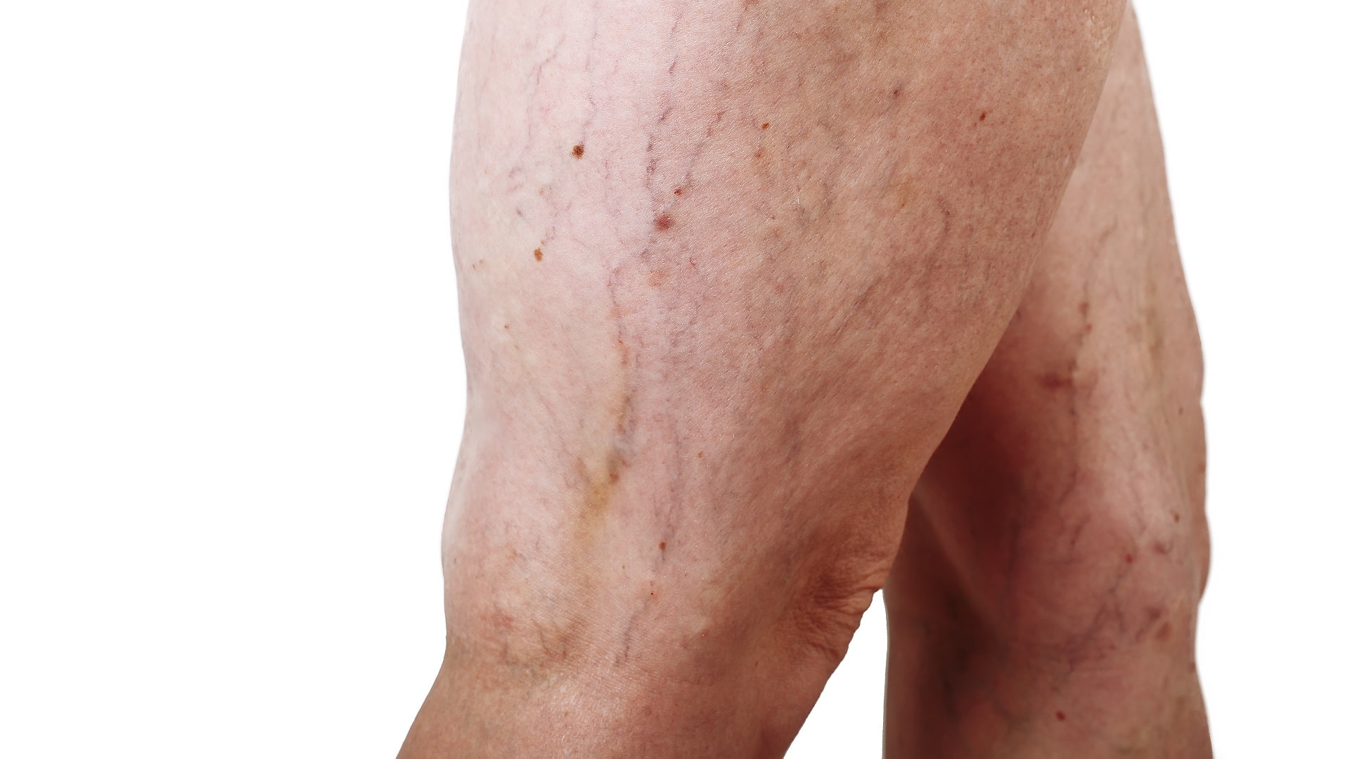 What is Venous Reflux Disease Here's What You Need to Know